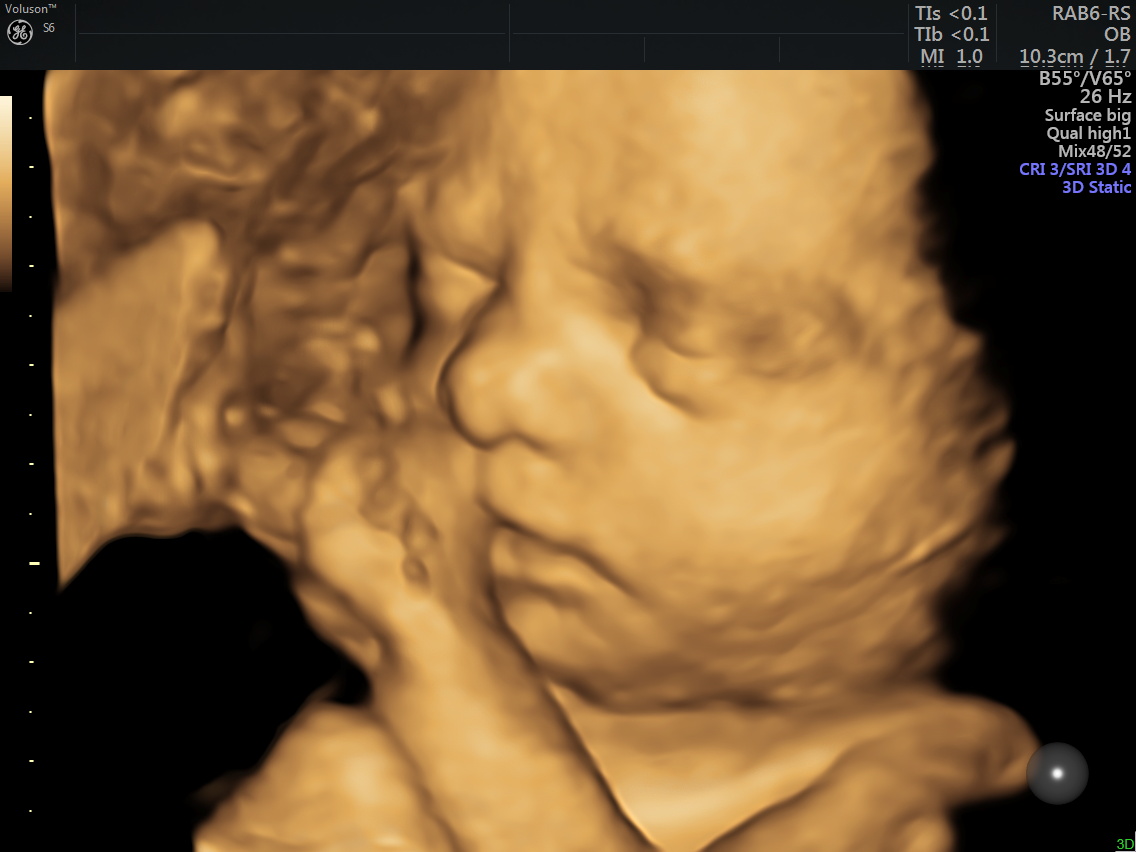 midyat ultrason &ccedil;ekimi